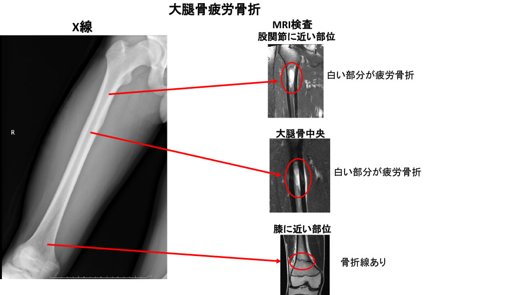 疲労 骨折 と は